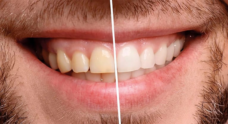 teeth whitening Moorooka dental