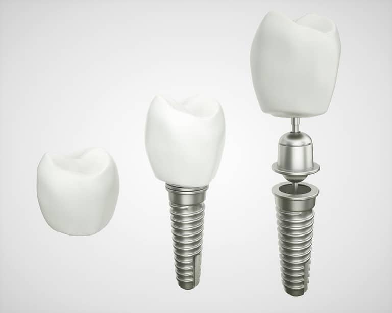 financing payment plans for dental implants