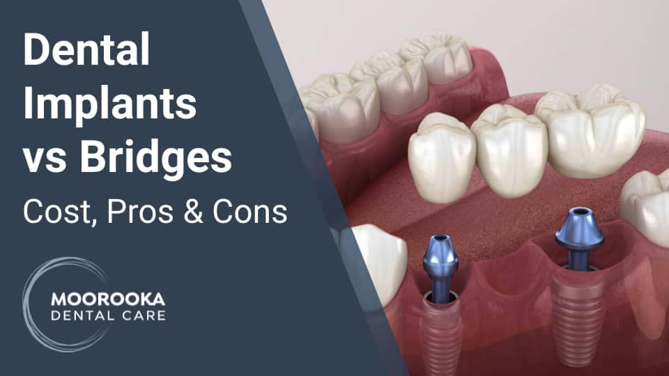 Dental Implants vs Bridges - What's The Difference