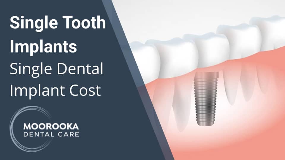 Single Tooth Dental Implant Cost in Australia 2023