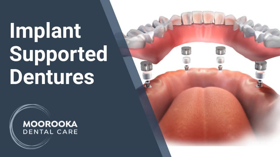 Implant Supported Dentures Australia Treatment Cost 2023