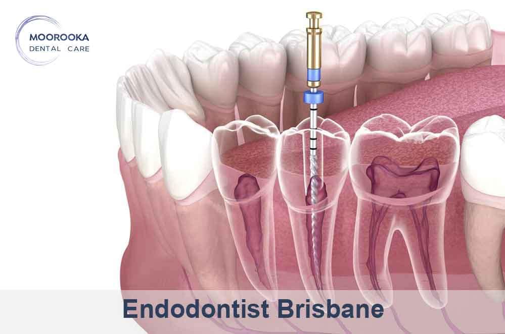 Endodontist Brisbane Affordable Root Canal Treatment