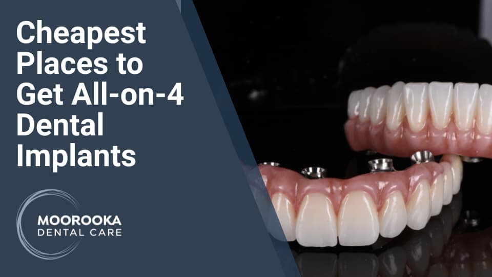 Most Affordable Places to Get AllOn4 Dental Implants MOOROOKA
