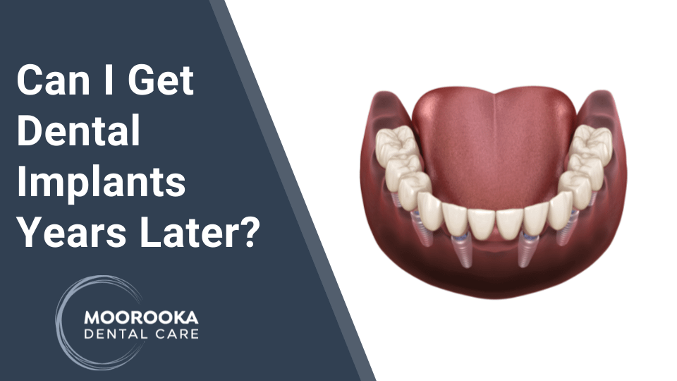 Can I Get A Dental Implant Years Later? MOOROOKA