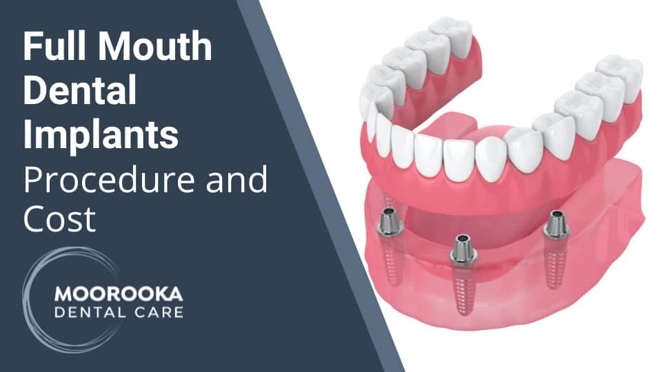 Full Mouth Dental Implant Procedure and Cost MOOROOKA