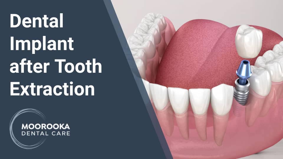 Dental Implant after Tooth Extraction MOOROOKA
